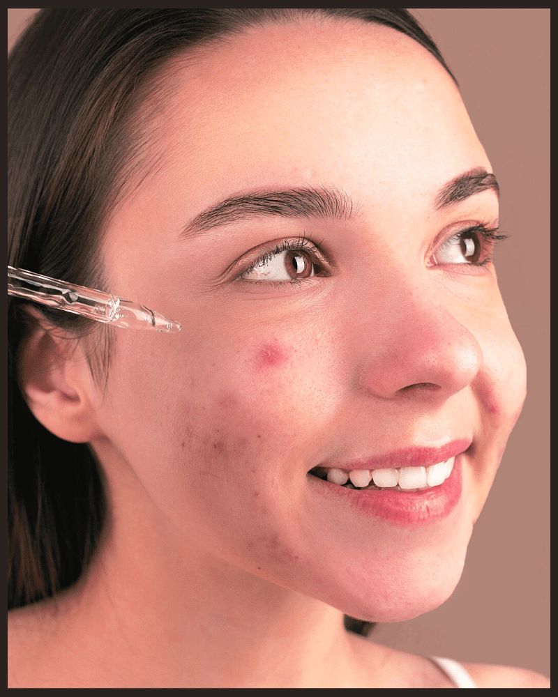 Is Hyaluronic Acid Good for Acne? Is There Any Evidence? Elite Selects